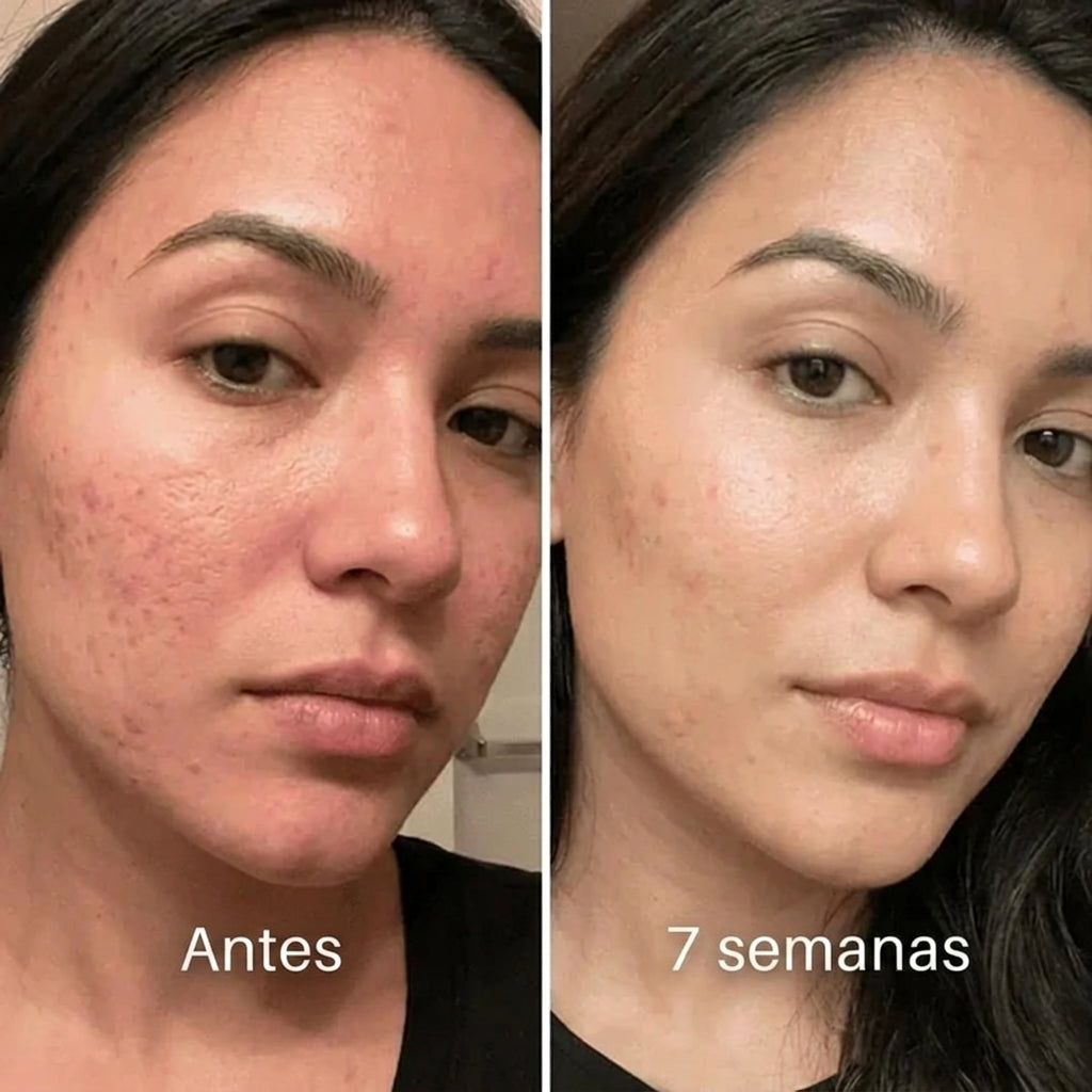 Pluune™: Balsamo clínico reparador de cicatrices de acné™