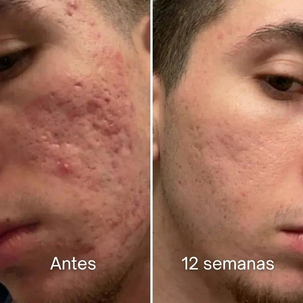 Pluune™: Balsamo clínico reparador de cicatrices de acné™